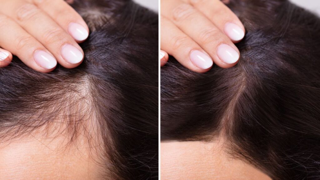 hair loss for women